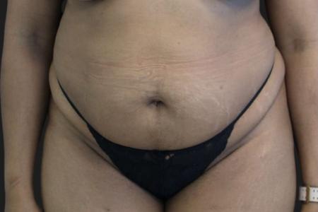 Before image 1 Case #119291 - 46 year-old Patient | Tummy Tuck