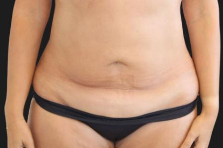 Before image 1 Case #119276 - 48 year-old Patient | Tummy Tuck