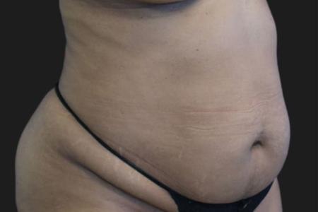 Before image 2 Case #119291 - 46 year-old Patient | Tummy Tuck