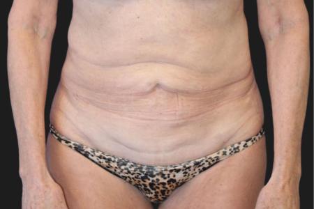 Before image 1 Case #119271 - Mid 60s Patient | Menopause Makeover