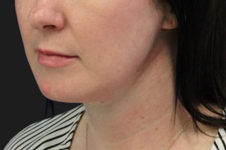 After image 1 Case #119226 - 43 year old Patient | Neck Lift 