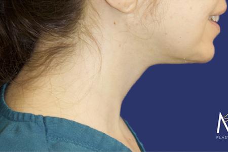 After Case #119361 - 43 year-old Patient | Neck Lift