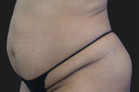 Before image 3 Case #119291 - 46 year-old Patient | Tummy Tuck