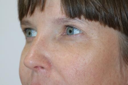 After image 3 Case #121406 - Upper Lid Blepharoplasty