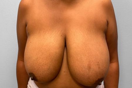 Before image 1 Case #120916 - Breast Reduction