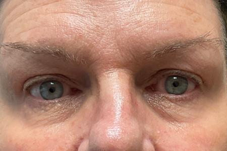After image 1 Case #120971 - 61 year old female with upper blepharoplasty