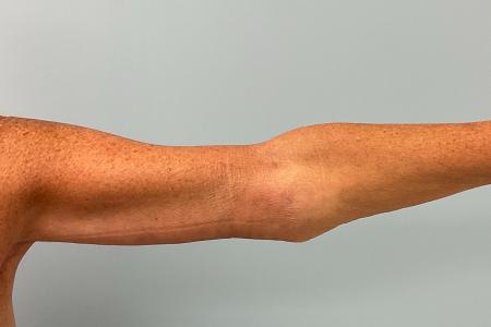 After image 1 Case #120626 - 64 year old female with Bilateral Brachioplasty
