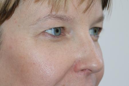 Before image 2 Case #121406 - Upper Lid Blepharoplasty