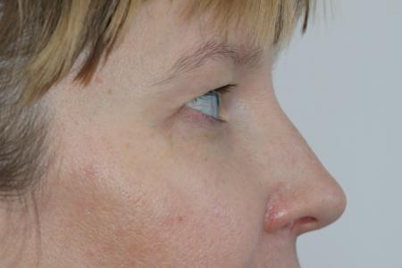 Before image 4 Case #121406 - Upper Lid Blepharoplasty
