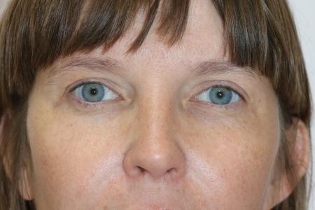 After image 1 Case #121406 - Upper Lid Blepharoplasty