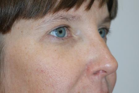 After image 2 Case #121406 - Upper Lid Blepharoplasty