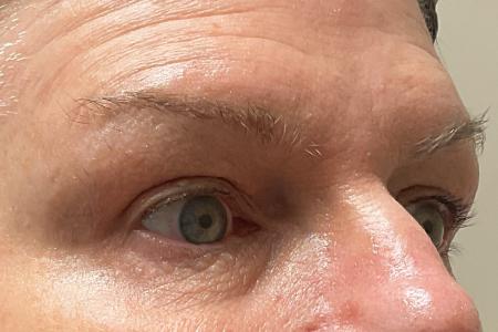 After image 2 Case #120971 - 61 year old female with upper blepharoplasty