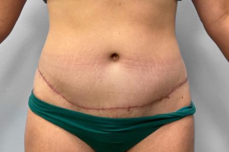 After image 1 Case #120861 - Abdominoplasty & Liposuction