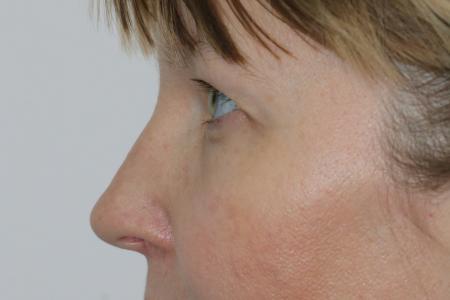 Before image 5 Case #121406 - Upper Lid Blepharoplasty