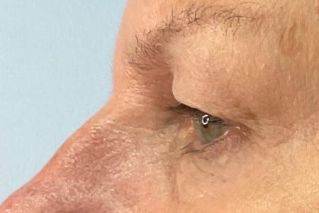 Before image 3 Case #120971 - 61 year old female with upper blepharoplasty