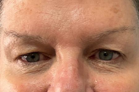 Before image 1 Case #120971 - 61 year old female with upper blepharoplasty