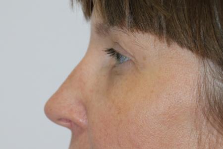 After image 5 Case #121406 - Upper Lid Blepharoplasty