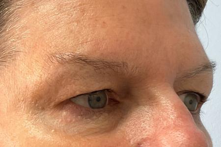 Before image 2 Case #120971 - 61 year old female with upper blepharoplasty
