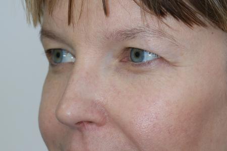 Before image 3 Case #121406 - Upper Lid Blepharoplasty