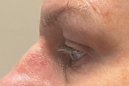 After image 3 Case #120971 - 61 year old female with upper blepharoplasty