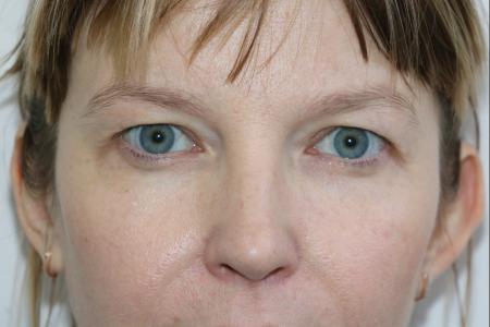 Before image 1 Case #121406 - Upper Lid Blepharoplasty
