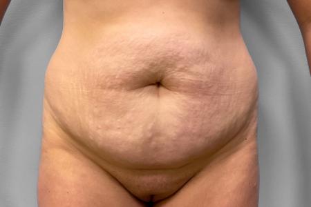 Before image 1 Case #120861 - Abdominoplasty & Liposuction