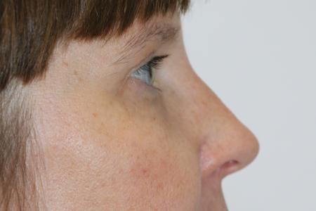 After image 4 Case #121406 - Upper Lid Blepharoplasty