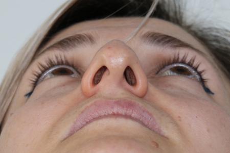 Before image 4 Case #122406 - Aesthetic Reduction Rhinoseptoplasty