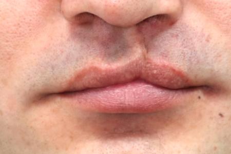 Before Case #122401 - Cleft Lip Revision