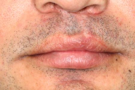 After Case #122401 - Cleft Lip Revision