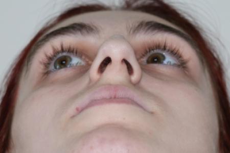 Before image 6 Case #122786 - Aesthetic Reduction Rhinoseptoplasty