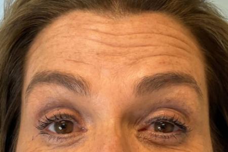 Before image 1 Case #123151 - 54 year old female with Botox