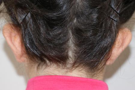 Before image 2 Case #123061 - Transhelical Scar Less Otoplasty