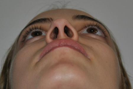 Before image 6 Case #122641 - Aesthetic Reduction Rhinoseptoplasty