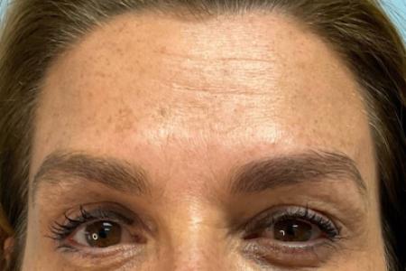 After image 1 Case #123151 - 54 year old female with Botox