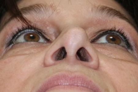 After image 6 Case #122596 - Aging Rhinoseptoplasty
