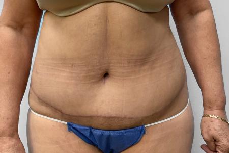 After image 1 Case #123196 - Tummy Tuck