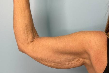 Before image 1 Case #123156 - 53 year old female with Arm Lift