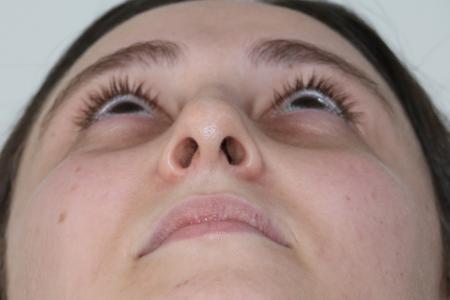 Before image 6 Case #122861 - Aesthetic Reduction Rhinoplasty