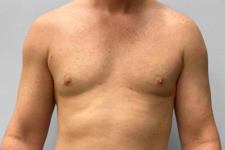 After image 1 Case #123226 - Gynecomastia Correction