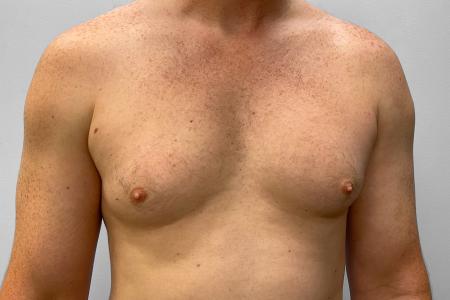 Before image 1 Case #123226 - Gynecomastia Correction