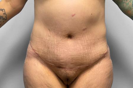 After image 1 Case #123231 - Tummy Tuck