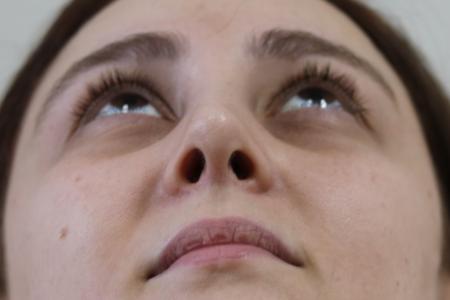 After image 6 Case #122861 - Aesthetic Reduction Rhinoplasty