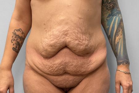 Before image 1 Case #123231 - Tummy Tuck