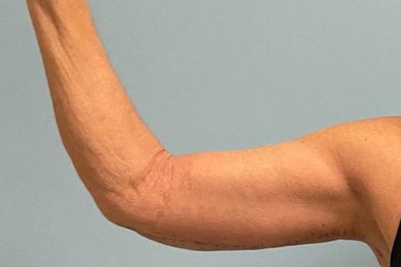 After image 1 Case #123156 - 53 year old female with Arm Lift