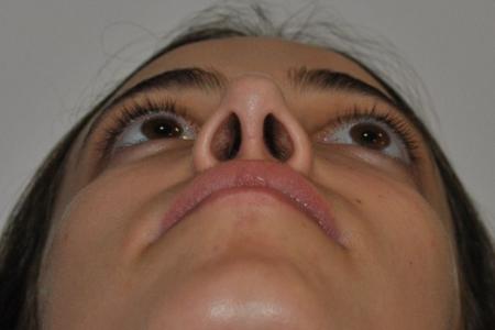 After image 6 Case #122641 - Aesthetic Reduction Rhinoseptoplasty