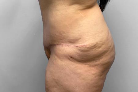 After image 3 Case #123221 - Tummy Tuck