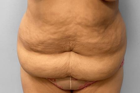 Before image 1 Case #123196 - Tummy Tuck