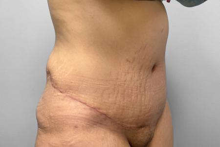 After image 2 Case #123231 - Tummy Tuck