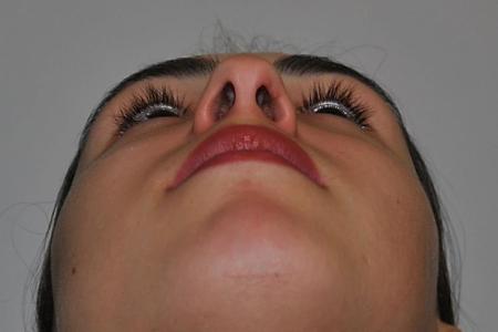 Before image 6 Case #122621 - Aesthetic Reduction Rhinoseptoplasty